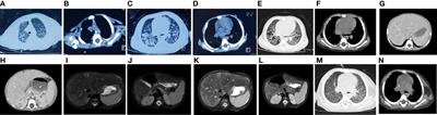 Disseminated Talaromyces marneffei Infection in a Non-HIV Infant With a Homozygous Private Variant of RELB